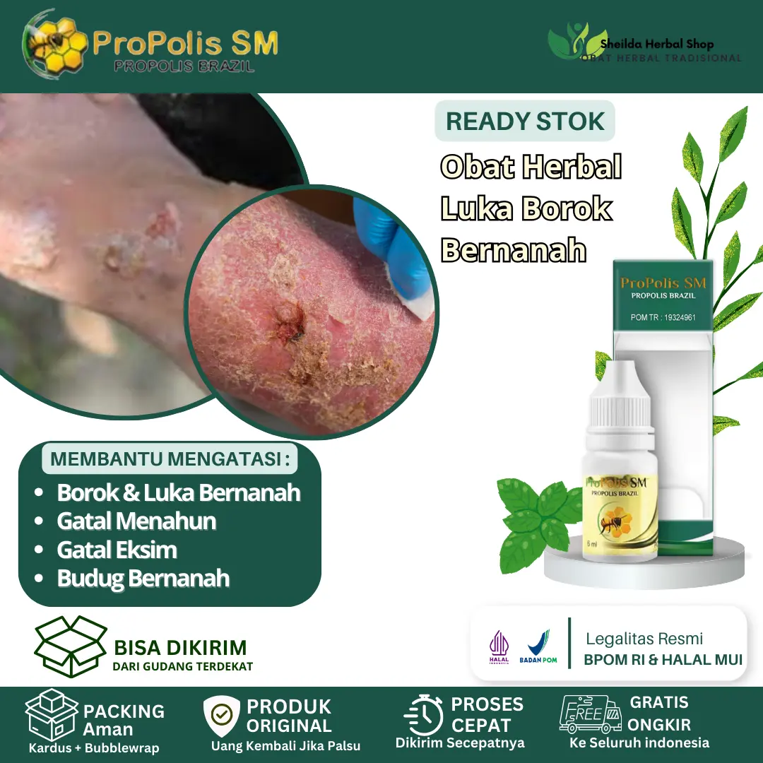 Propolis SM  Tetes Borok, Obat Luka Bernanah, Obat Gatal Menahun, Obat Gatal Berair, Gatal  Merah Eksim Bernanah Budug