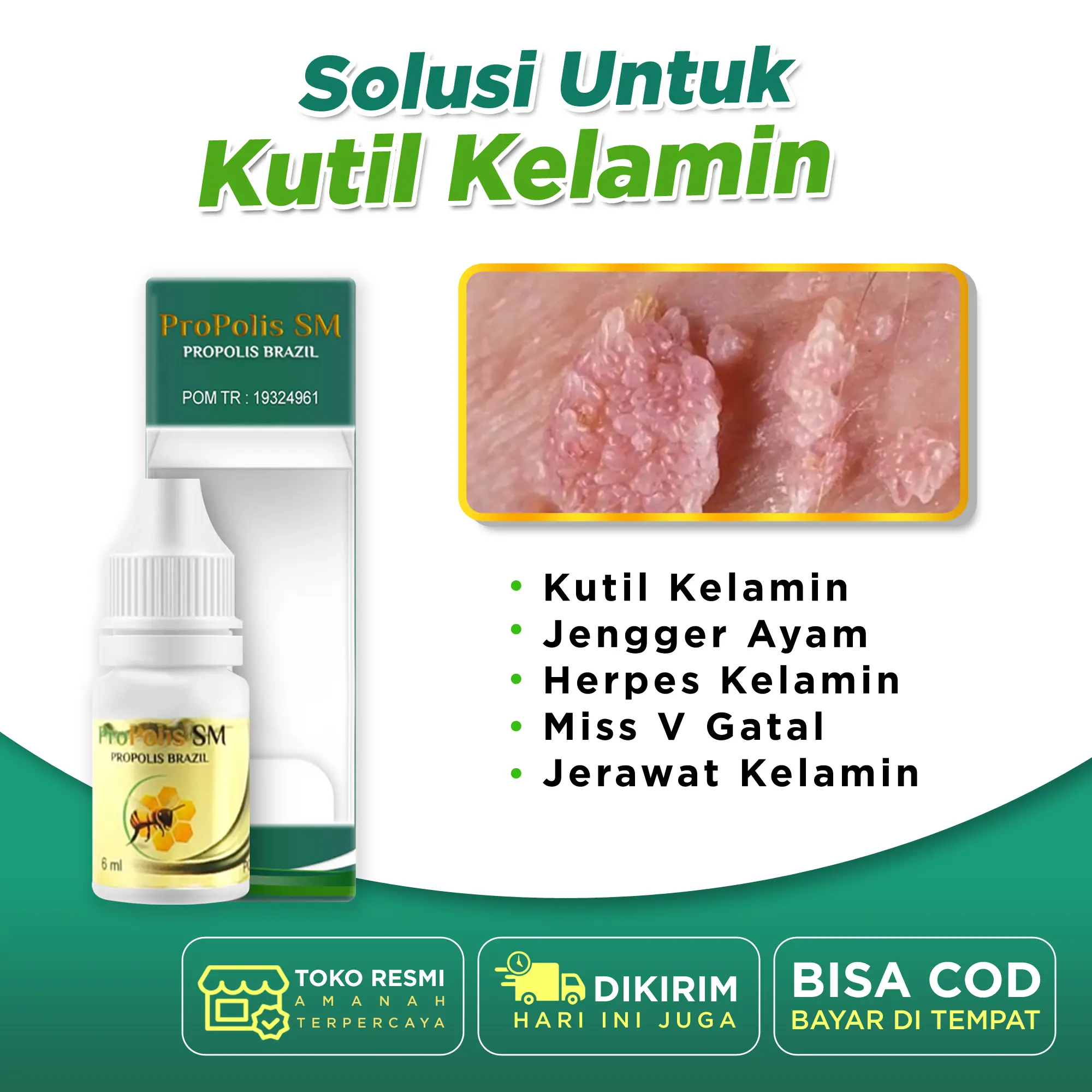 Propolis SM Brazil Kutil Kelamin Pria Wanita HPV Jengger Ayam Beruntusan Gatal Pada Kelamin