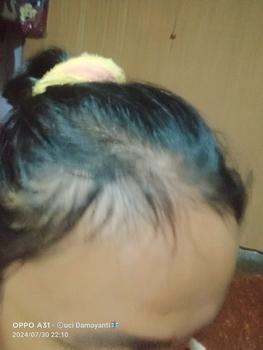 Product Review of [ BISA COD ] PAKET 5 PCS 145RB HAIR TONIK PENYUBUR RAMBUR ANTI HAIRFALL from N**i c**💖 0
