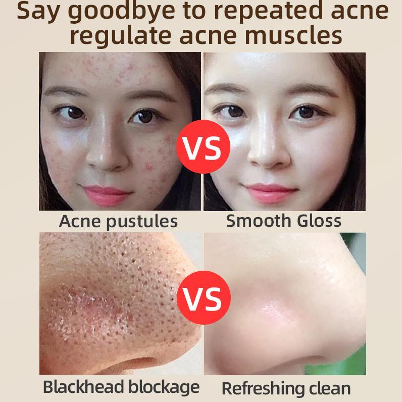 （T1）BPOM.Beli 2 Gratis 1.Challenge 7 Hari Jerawat Hilang,CINSULIN Obat Jerawat Herbal Ekstrak Alami Cepat Hilangkan Komedo & Jerawat Meradang  BPOM Certified  Aman untuk Remaja & Kulit Sensitif Berjerawat Wajah Gatal Beruntusan 4