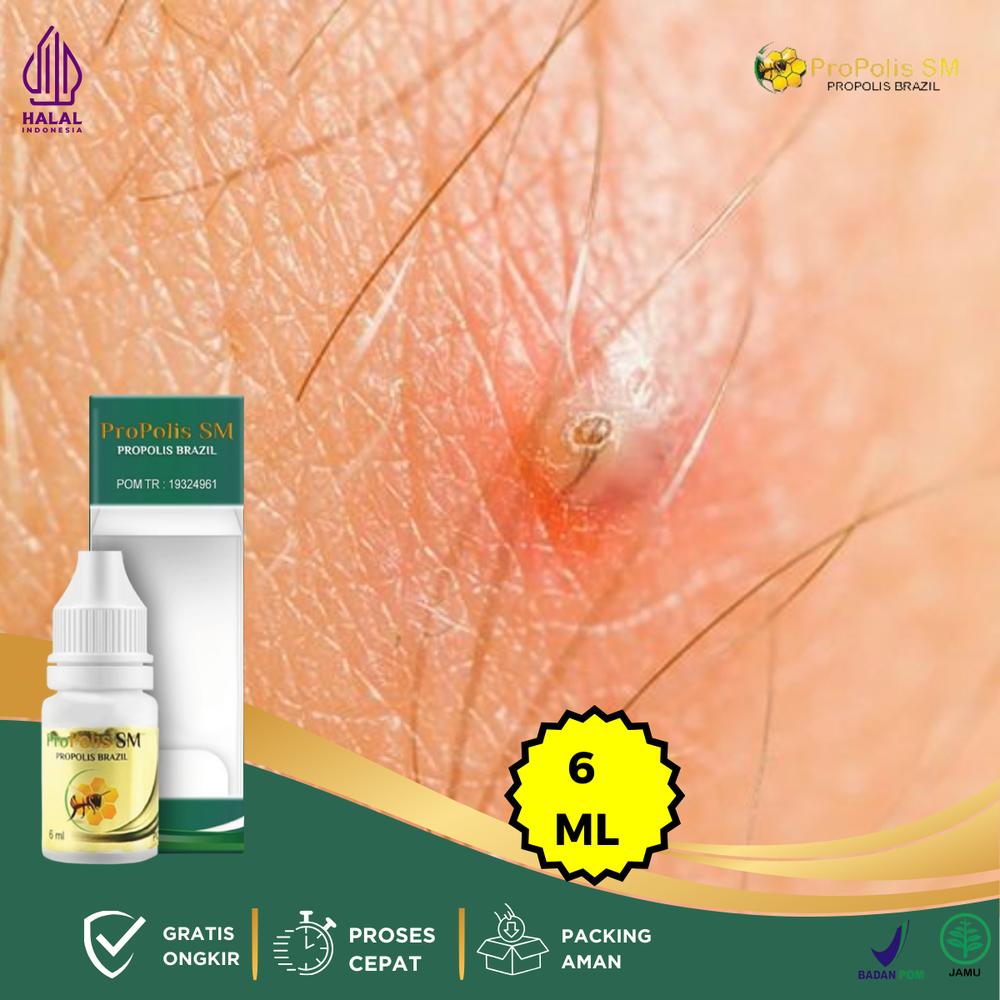 Tetes Penghilang Benjolan Di Miss v, Kutil Kelamin, Bisul, Herpes Genital, V4gina Gatal Dan Bau, Virus HPV, Sipilis, Infeksi Jamur - Propolis SM