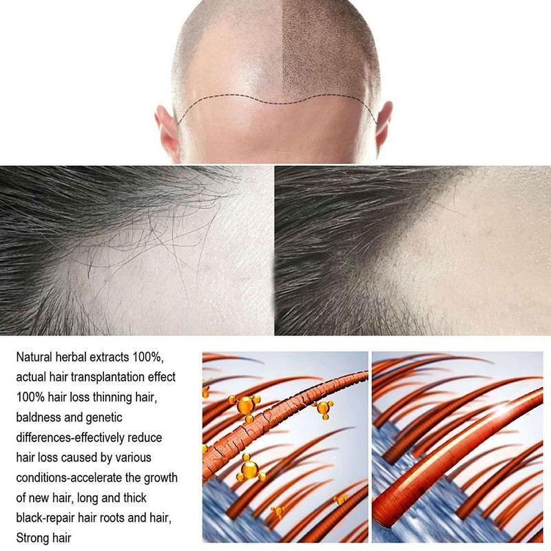 JAYSUING Rambut Serum Penumbuh Rambut Cepat Hair Growth Spray Obat Penumbuh Rambut Penumbuh Rambut Botak Serum 120ML