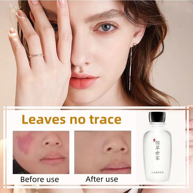 Product Introduction of Birthmark Remover Solution 100g Birthmark Removal liquid for Black, red, brown birthmarks on face Quick Remove Birthmark Penyingkiran Tanda Lahir 0
