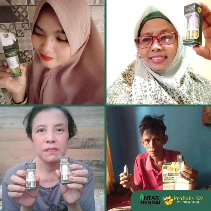 Propolis SM Kutil Papiloma, Perontok Daging Tumbuh, Penghilang Kutil Di Leher, Kutil Di Tangan, Kutil Di Kaki, Kutil Di Wajah, Menghilangkan Daging Jadi Skin Tag 1