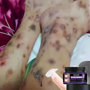 EELHOE Menghilangkan bekas luka dengan cepat Penghilang Bekas Luka Koreng Advanced Scar Gel Dermatik Obat Bekas Luka Luka Jahitan Bekas Luka Jerawat Dan Stretch Marks Penghilang Strechmark Ampuh