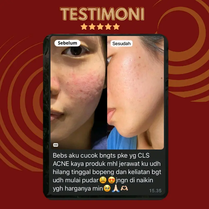TERLARIS! ACNE TREATMENT SERIES Perawatan 1