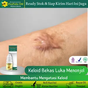 Propolis SM - Salep untuk menghilangkan keloid, menghilangkan keloid menonjol, menghilangkan benjolan bekas luka, menghilangkan daging jadi