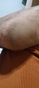 Product Review of JC Callus Remover for Damaged and Cracked Heel With Wooden Foot File Eucalyptus Scented At Home Foot Spa Session Soft  Moisturizer Dry Skin Oil Peeling Nails Moisture Hydrate Hydrating from l**y m**n a**} 2