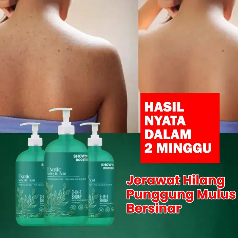 Leeva Sabun Exotic Acne 250ml - Sabun Mandi Kulit Sensitif, Mengatasi Jerawat & Panu, Melembabkan Kulit Kering, Solusi Kulit Sehat dan Bersih 0