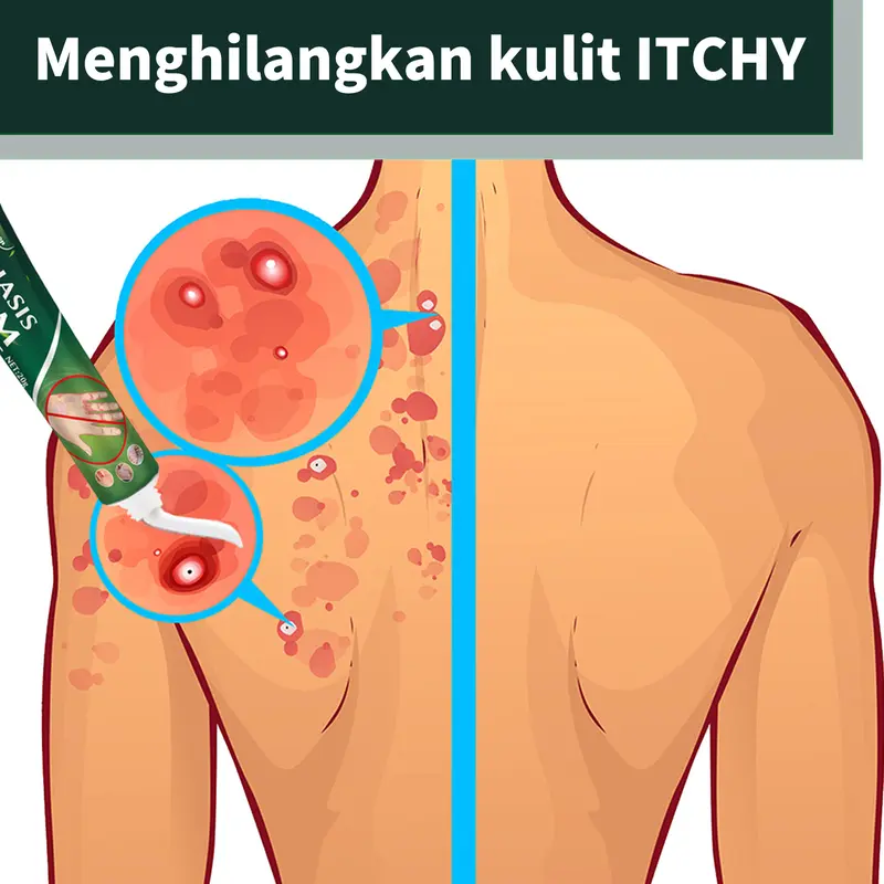 Product Introduction of South Moon Krim Kulit Sapi Memperbaiki Dermatitis Dermatitis Dermatitis Lumut Lumut Tangan dan Kaki Meringankan Eksim Gatal Krim Antipruritic Krim Salep Topikal Kulit 1