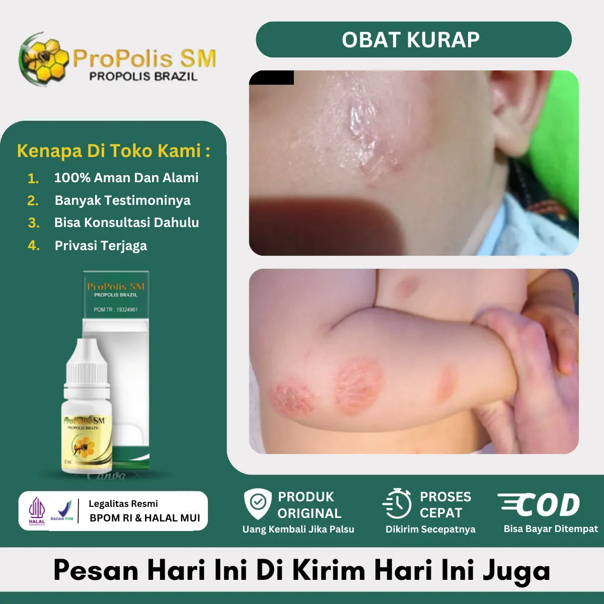 Propolis SM Kurap untuk Bayi, Gatal Untuk Anak 2 Tahun,  Penghilang Kurap di Wajah, Penghilang Ruam Popok Bayi, Tetes Gatal Biang Keringat, Jamur Kulit di Tangan / Kaki, Kurap di Pipi, Ringworm
