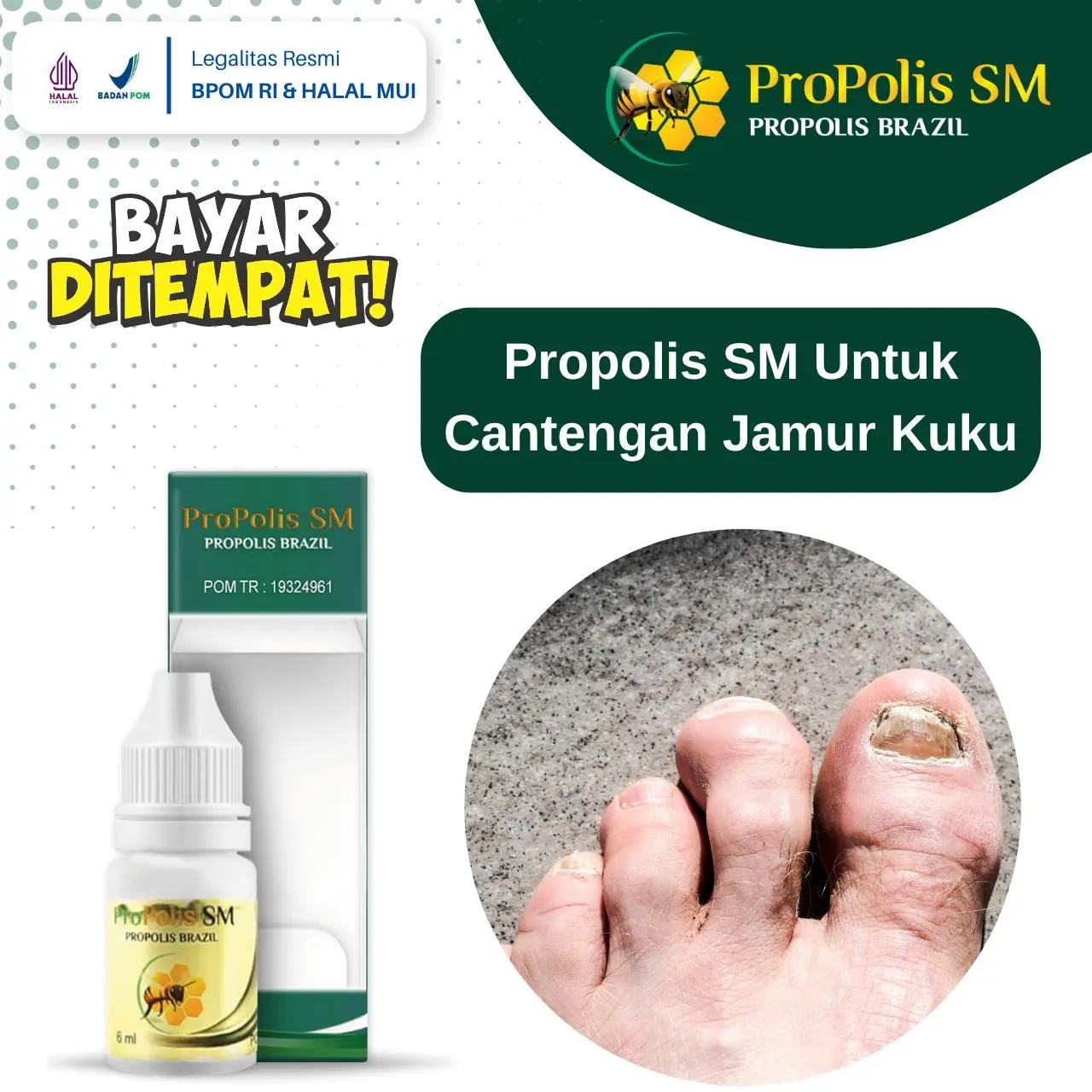 Cantengan Jempol Kuku, Jamur Kuku Bau Busuk, Jempol Kaki Kuku Rusak - Propolis SM