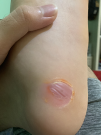 Gambar Plester Kutil Mata Ikan Kaki Kapalan Ji Yan Gao Obat Kutil Mata Ikan dari Aneka Grosir Dhamira Kota Bekasi 4 Tokopedia