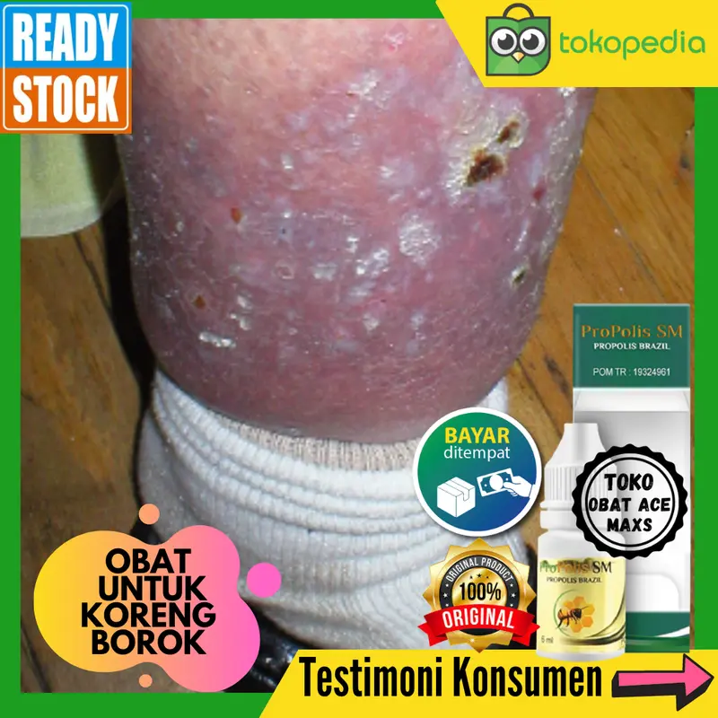 Obat Koreng Borok, Obat Koreng , Obat Koreng Di Kaki - PROPOLIS SM 0