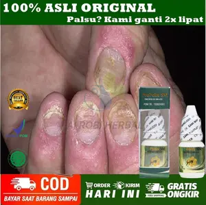Obat Kuku Rusak dan Jamur - Obat Kuku Rusak - Prosiasis Kuku Jamur
