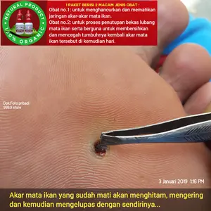 Obat penyakit mata ikan atau clavus bukan plester salep callusol