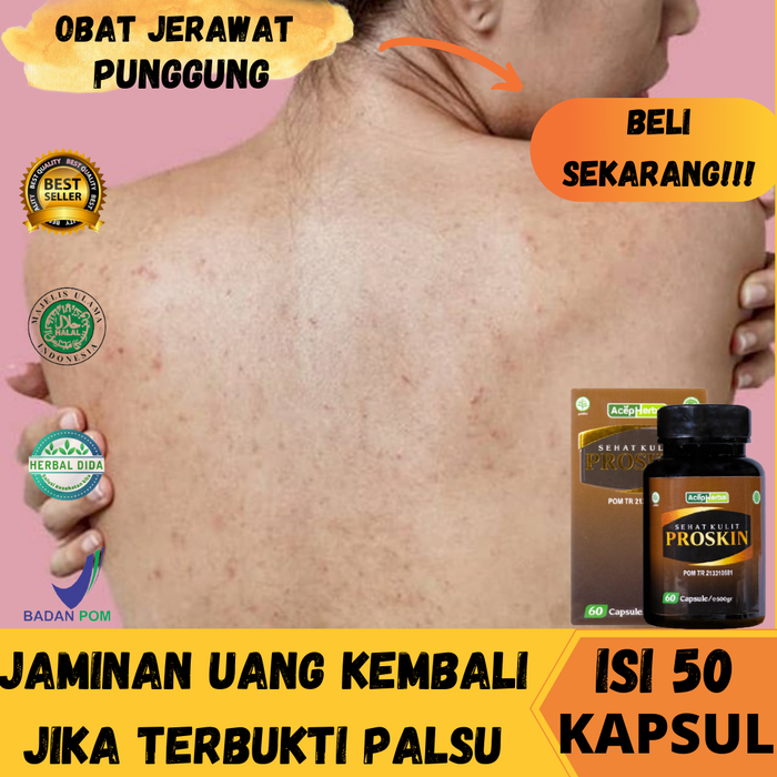 Gambar Obat Jerawat Punggung, Obat Jerawat di Punggung Dan Bekasnya, PROSKIN dari Herbalthy Store Kota Administrasi Jakarta Barat Tokopedia