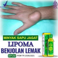 Gambar Minyak Benjolan Obat Benjolan Lipoma, Benjolan - MINYAK SAPU JAGAT dari SB Herbal Store Kota Administrasi Jakarta Barat 1 Tokopedia