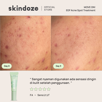 Gambar SKINDOZE Move On Acne Spot Treatment dari Skindoze Kota Administrasi Jakarta Barat 5 Tokopedia