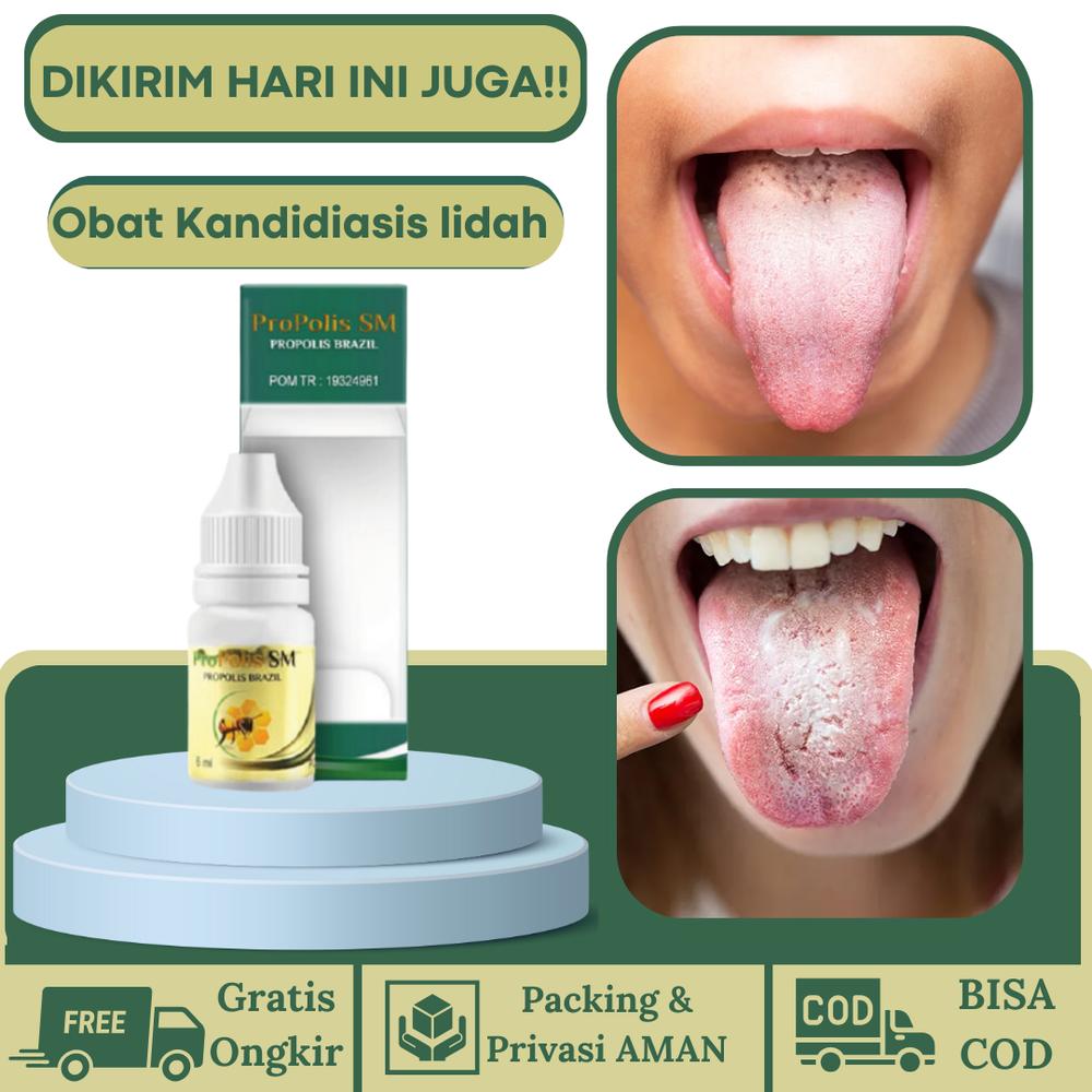 Obat Kandidiasis Mukokutan Radang Lidah Obat Lidah Berjamur