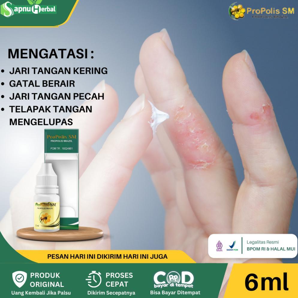 Obat Jari Tangan Kering, Obat Telapak Tangan Kasar, Obat Telapak