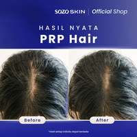 Gambar SOZO SKIN PRP hair Treatment - 1X dari Sozo Skin Kota Administrasi Jakarta Selatan 3 Tokopedia