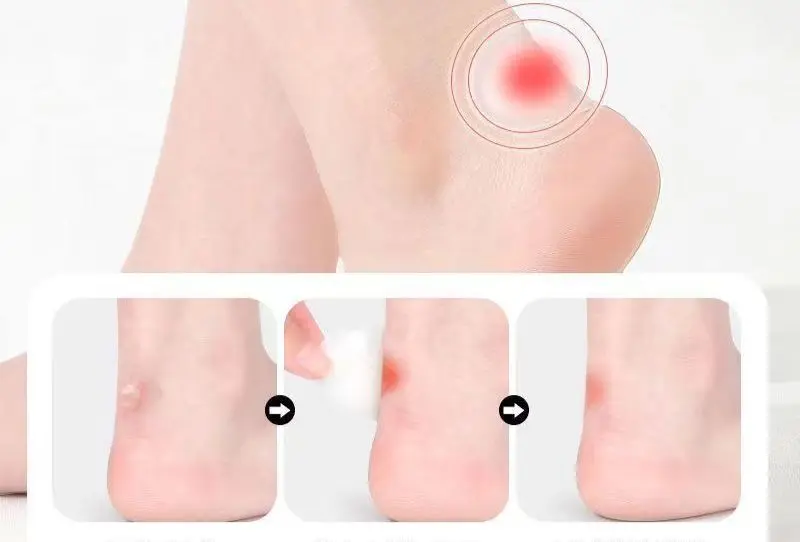 STIKER PLESTER PELINDUNG KAKI TUMIT ANTI LECET MULTIFUNGSI UNIVERSAL AREA SEMUA KAKI DAN TANGAN BAHAN PREMIUM 5