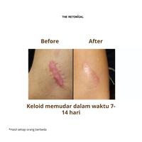 Gambar Bundling 5pcs The Retonical Almond Body Balm Penghilang Bekas Luka | Krim untuk merawat kulit gatal Eksim & Sensitif dari The Retonical Kota Bandung 3 Tokopedia