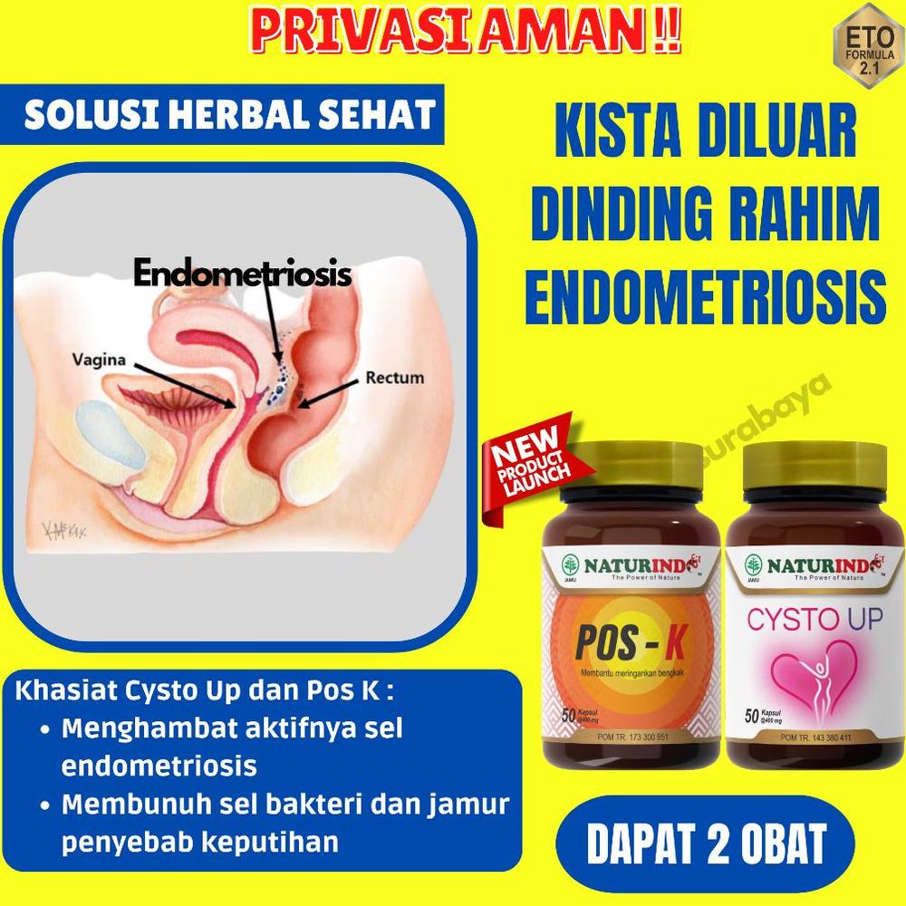 Obat kista dan miom myom Di Luar Dinding Rahim Herbal Coklat Kista endometriosis cysta Bartholin ampuh myom kista ovarium penyakit rahim herbal ampuh bpom
