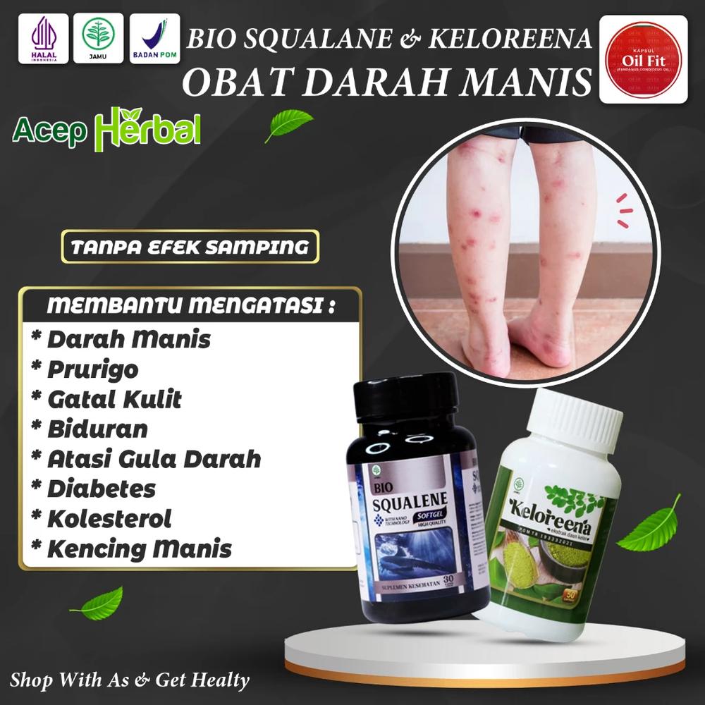 OBAT DARAH MANIS PRURIGO ANAK DAN DEWASA BEKAS LUKA GATAL GATAL KULIT KORENGAN EXSIM KERING DAN BASAH PSORIASIS BUDUG BOROK BERNANAH BERAIR ALAMI KELOREENA EKSTRAK DAUN KELOR & BIO SQUALENE SOFTEGEL M