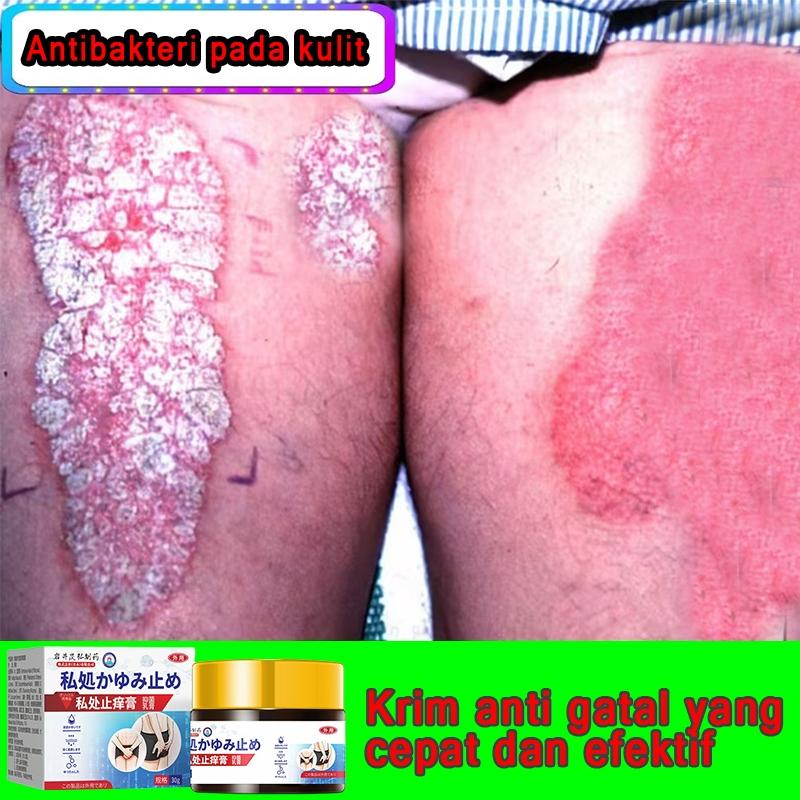gatal paling obat gatal selangan obat gatal kewanitaan obat selangan gatal dan hitam Menghilangkan Kurap
