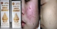Gambar OBAT JERAWAT MINYAK OLES JAMU dari Gizela Shop_Archived Jakarta Barat 1 Tokopedia