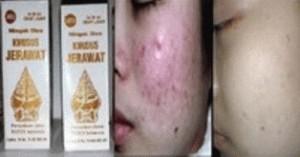 Gambar OBAT JERAWAT MINYAK OLES JAMU dari Gizela Shop_Archived Jakarta Barat Tokopedia