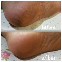 Gambar silikon gel pelindung tumit kaki dari cecil's shop Kab. Bogor 4 Tokopedia