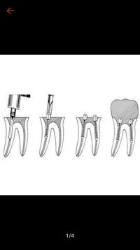 Gambar Pasak Logam/Pin Screw Gold Eceran dari Dental Jaya Official Kota Yogyakarta 5 Tokopedia