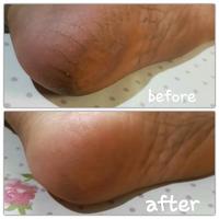 Gambar Silikon soft gel heel /pelindung tumit kaki / ANti kasar pecah-pecah dari KemanggisanStore Kota Administrasi Jakarta Barat 4 Tokopedia