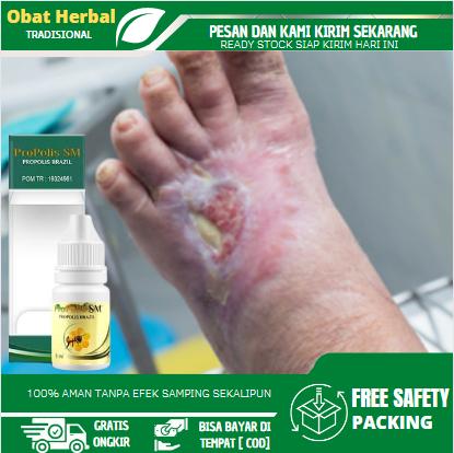 Cairan Tetes Pengering Luka Diabetes, Luka Diabetes Agar Cepat Kering, Luka Bernanah, Diabetes Kencing Manis Dengan Propolis SM