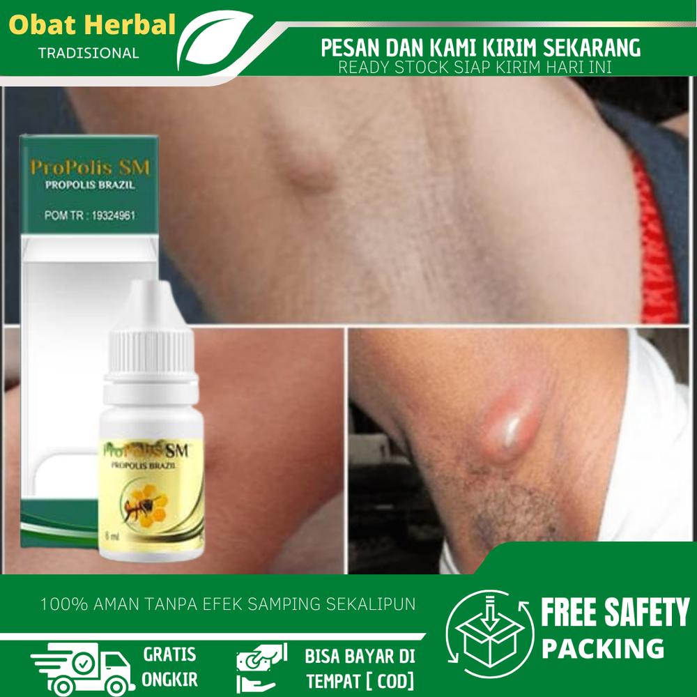 Penghancur Benjolan Di Ketiak, Benjolan Di Bawah Ketiak, Bisul Di Ketiak, Lipoma di Ketiak, Benjolan Uci Uci, Penghilang Benjolan Dengan Propolis SM